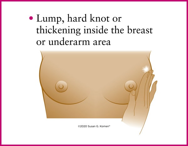 Symptoms of breast cancer