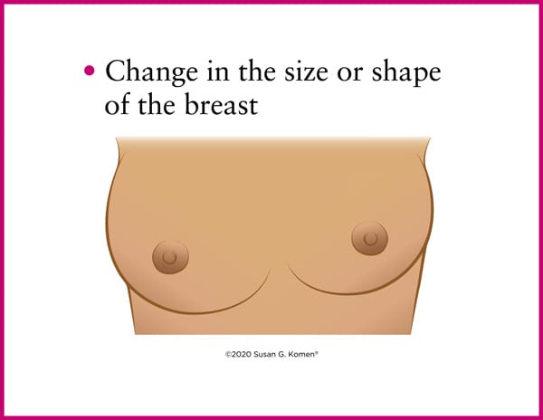 Having one breast slightly bigger than the other is not unusual
