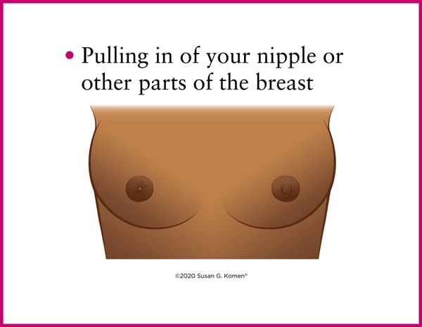 Warning Signs of Breast Cancer