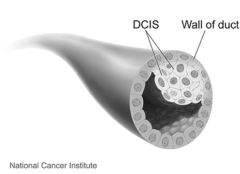 Ductal carcinoma in situ illustration
