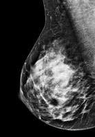 More breast density