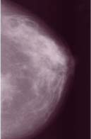 More breast density
