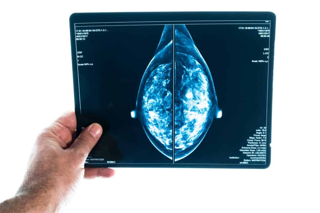 X-ray,Digital,Mammogram,Or,Mammography,Is,X-ray,Image,Of,The