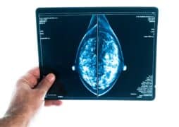 X-ray,Digital,Mammogram,Or,Mammography,Is,X-ray,Image,Of,The