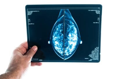 X-ray,Digital,Mammogram,Or,Mammography,Is,X-ray,Image,Of,The