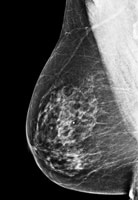 Some breast density
